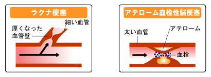 ラクナ梗塞とアテローム血栓性梗塞