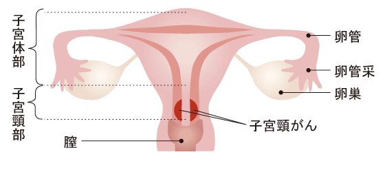 子宮頸がん