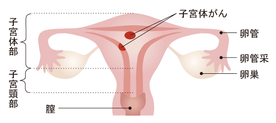 子宮体がん