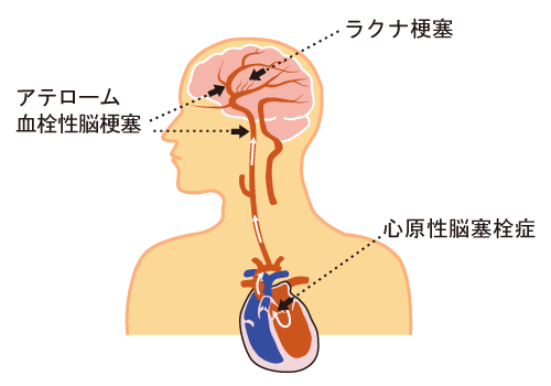 アテローム 血栓 性 脳 梗塞