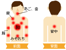 梗塞 背中 心筋 もうすぐ脳梗塞・心筋梗塞になる人の簡便な判定法 「背中に枕」法｜真島消化器クリニック