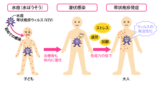 帯状疱疹とは