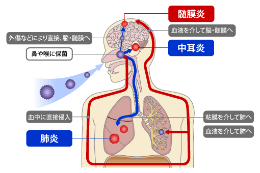 肺炎のしくみ