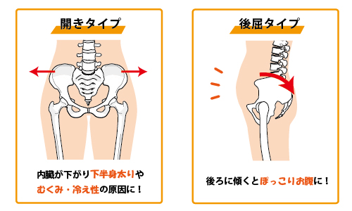 骨盤のゆがみ