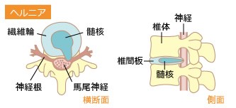 椎間板ヘルニア